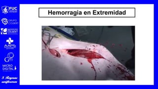 Hemorragia en Extremidad
 