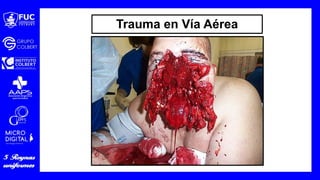 Trauma en Vía Aérea
 
