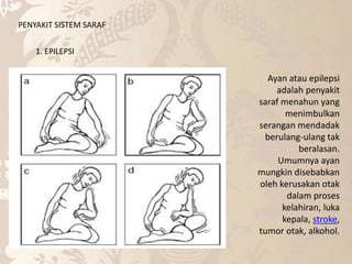 PENYAKIT SISTEM SARAF
1. EPILEPSI
Ayan atau epilepsi
adalah penyakit
saraf menahun yang
menimbulkan
serangan mendadak
berulang-ulang tak
beralasan.
Umumnya ayan
mungkin disebabkan
oleh kerusakan otak
dalam proses
kelahiran, luka
kepala, stroke,
tumor otak, alkohol.
 