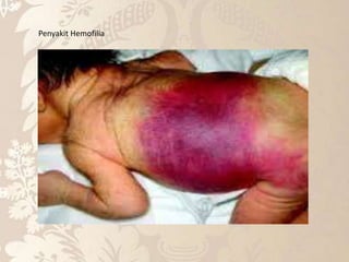 Penyakit Hemofilia
 