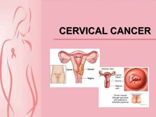 CERVICAL CANCER
 