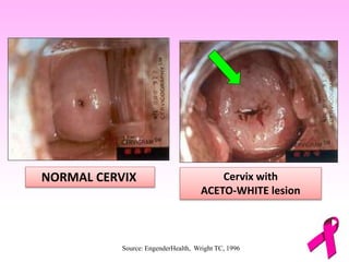 Source: EngenderHealth, Wright TC, 1996
NORMAL CERVIX Cervix with
ACETO-WHITE lesion
 