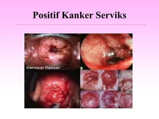 Positif Kanker Serviks
 