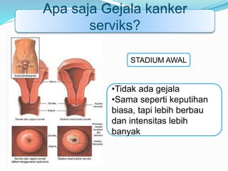 •Tidak ada gejala
•Sama seperti keputihan
biasa, tapi lebih berbau
dan intensitas lebih
banyak
STADIUM AWAL
Apa saja Gejala kanker
serviks?
 
