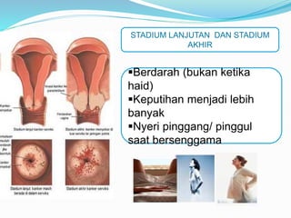 Berdarah (bukan ketika
haid)
Keputihan menjadi lebih
banyak
Nyeri pinggang/ pinggul
saat bersenggama
STADIUM LANJUTAN DAN STADIUM
AKHIR
 