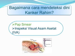 Bagaimana cara mendeteksi dini
Kanker Rahim?
Pap Smear
Inspeksi Visual Asam Asetat
(IVA)
 
