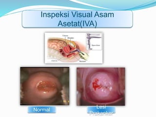 Normal
Lesi
Prakanker
Inspeksi Visual Asam
Asetat(IVA)
 