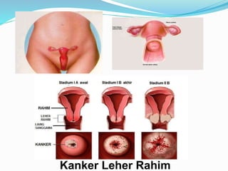 Kanker Leher Rahim
 