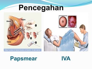 Papsmear IVA
Pencegahan
 
