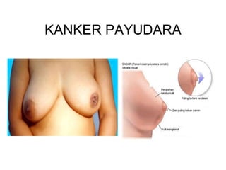 KANKER PAYUDARA
 