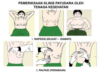 PEMERIKSAAN KLINIS PAYUDARA OLEH
TENAGA KESEHATAN
1. INSPEKSI (DILIHAT – DIAMATI)
2. PALPASI (PERABAAN)
 