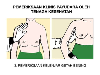 PEMERIKSAAN KLINIS PAYUDARA OLEH
TENAGA KESEHATAN
3. PEMERIKSAAN KELENJAR GETAH BENING
 