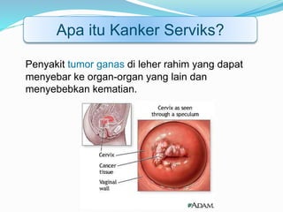 Penyakit tumor ganas di leher rahim yang dapat
menyebar ke organ-organ yang lain dan
menyebebkan kematian.
Apa itu Kanker Serviks?
 