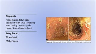 Diagnosis
menemukan telur pada
sediaan basah tinja langsung
atau cacing dewasa pada
pemeriksaan kolonoskopi
Pengobatan :
Albendazol
Mebendazol
 