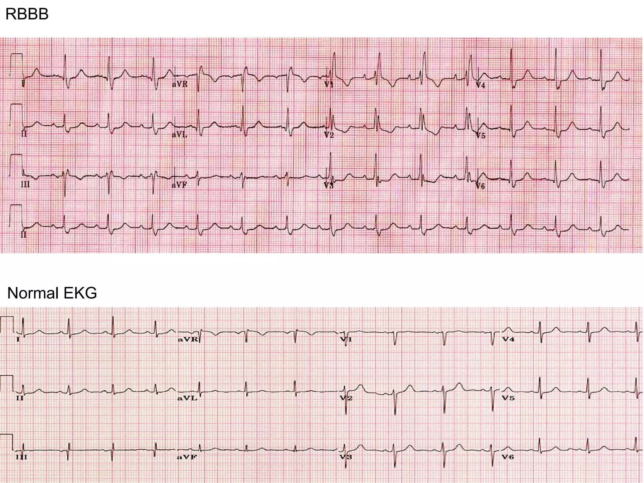 Acute Coronary Syndome | PPT