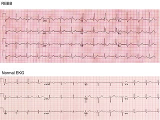 RBBB
Normal EKG
 