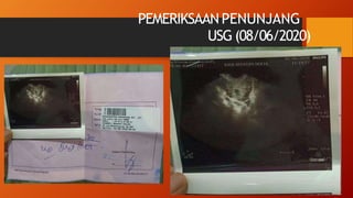 PEMERIKSAAN PENUNJANG
USG (08/06/2020)
 