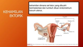 KEHAMILAN
EKTOPIK
kehamilan dimana sel telur yang dibuahi
berimplantasi dan tumbuh diluar endometrium
kavum uterus.
 
