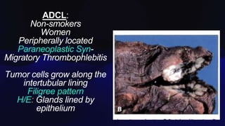 ADCL:
Non-smokers
Women
Peripherally located
Paraneoplastic Syn-
Migratory Thrombophlebitis
Tumor cells grow along the
intertubular lining
Filigree pattern
H/E Glands lined by
epithelium
 