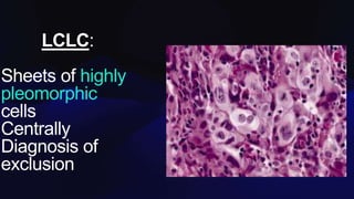 LCLC:
Sheets of highly
pleomorphic
cells
Centrally
Diagnosis of
exclusion
 