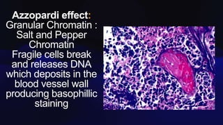 Azzopardi effect
Granular Chromatin :
Salt and Pepper
Chromatin
Fragile cells break
and releases DNA
which deposits in the
blood vessel wall
producing basophillic
staining
 
