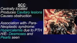 SCC:
Centrally located
Produces Cavitary lesions
Causes obstruction
Association with- Para-
Neoplastic syndrome:
Hypercalemia due to PTH
H/E- Desmoses and
Pearls seen
 