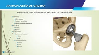 cadera.pptx