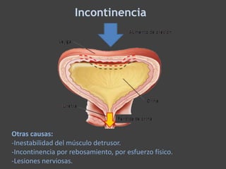 Incontinencia
Otras causas:
-Inestabilidad del músculo detrusor.
-Incontinencia por rebosamiento, por esfuerzo físico.
-Lesiones nerviosas.
 