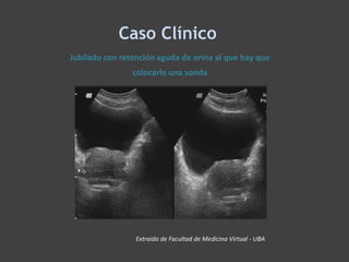Caso Clínico
Extraído de Facultad de Medicina Virtual - UBA
Jubilado con retención aguda de orina al que hay que
colocarle una sonda
 