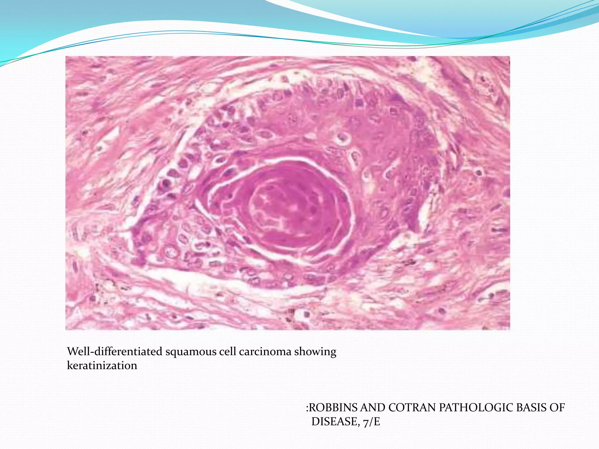 Well-differentiated squamous cell carcinoma showing
keratinization

:ROBBINS AND COTRAN PATHOLOGIC BASIS OF
DISEASE, 7/E

 