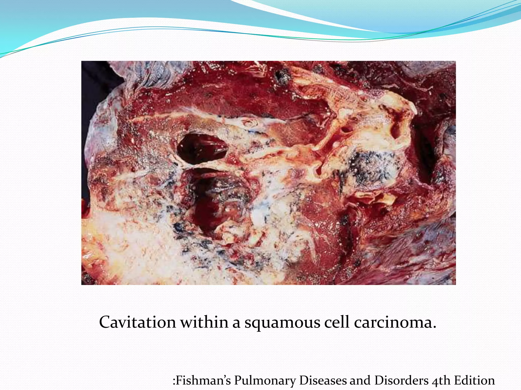 Cavitation within a squamous cell carcinoma.
:Fishman’s Pulmonary Diseases and Disorders 4th Edition

 