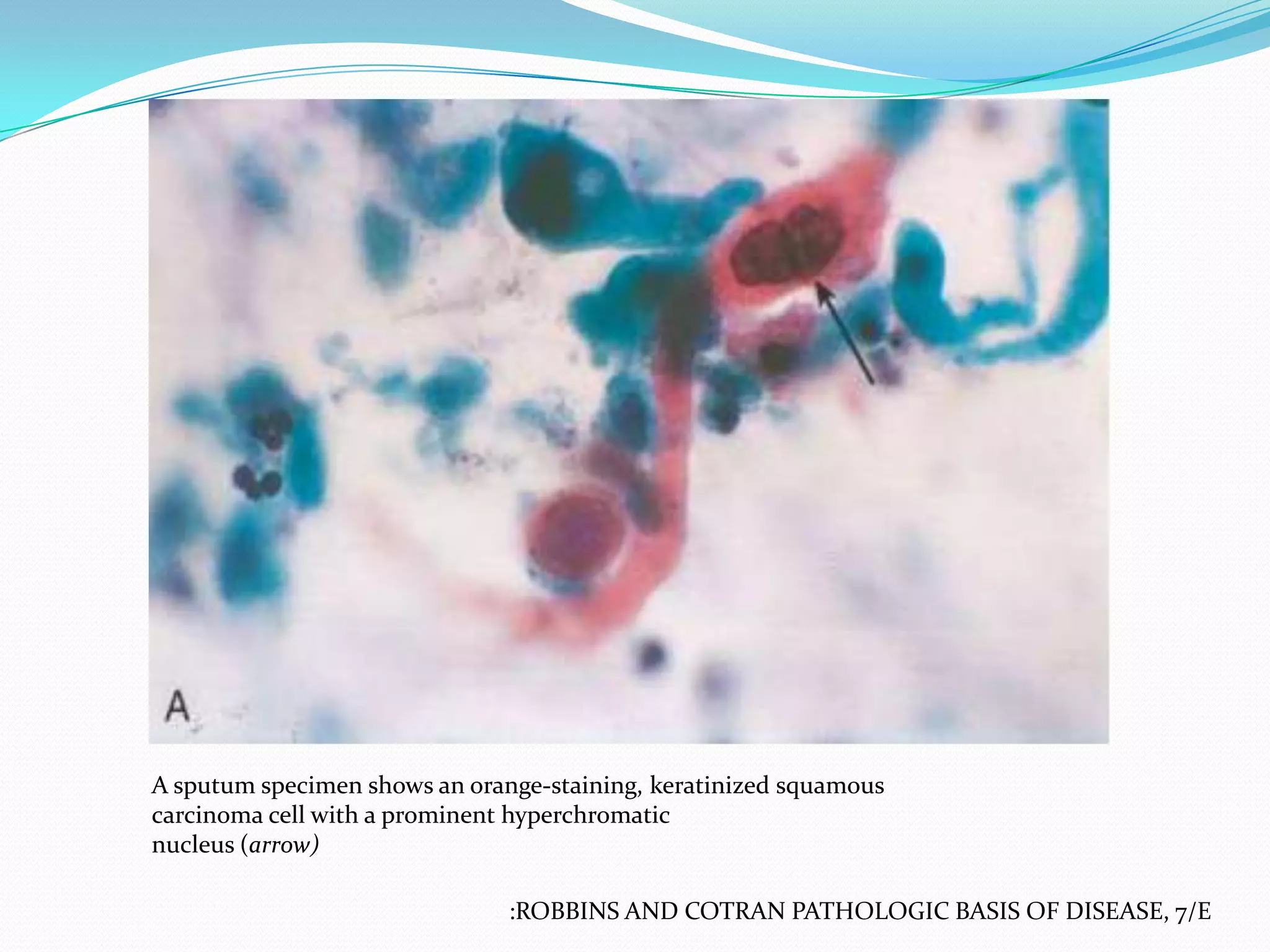 A sputum specimen shows an orange-staining, keratinized squamous
carcinoma cell with a prominent hyperchromatic
nucleus (arrow)
:ROBBINS AND COTRAN PATHOLOGIC BASIS OF DISEASE, 7/E

 