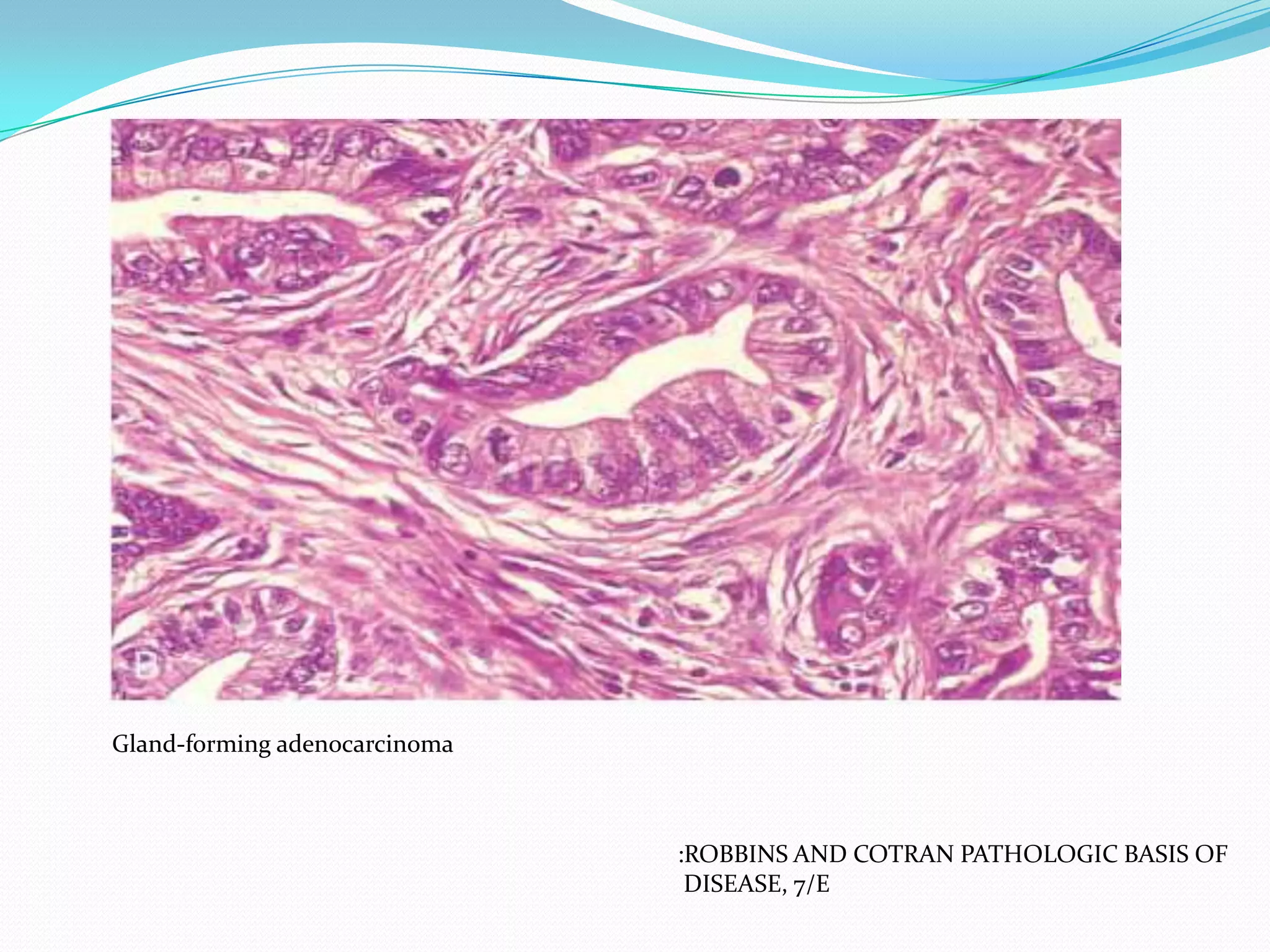 Gland-forming adenocarcinoma

:ROBBINS AND COTRAN PATHOLOGIC BASIS OF
DISEASE, 7/E

 