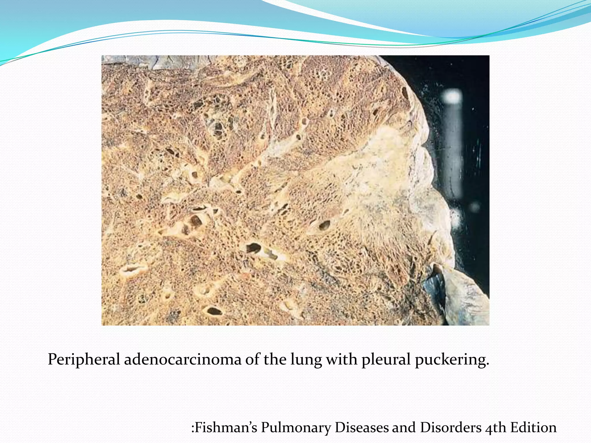 Peripheral adenocarcinoma of the lung with pleural puckering.

:Fishman’s Pulmonary Diseases and Disorders 4th Edition

 