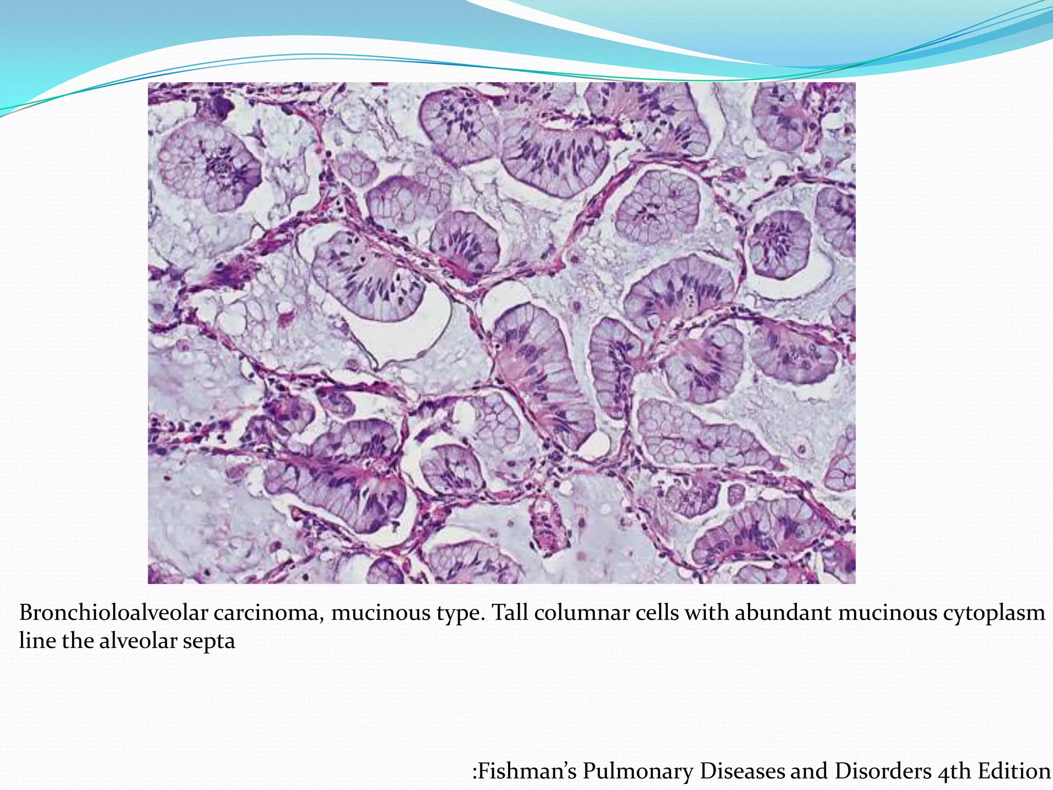Bronchioloalveolar carcinoma, mucinous type. Tall columnar cells with abundant mucinous cytoplasm
line the alveolar septa

:Fishman’s Pulmonary Diseases and Disorders 4th Edition

 