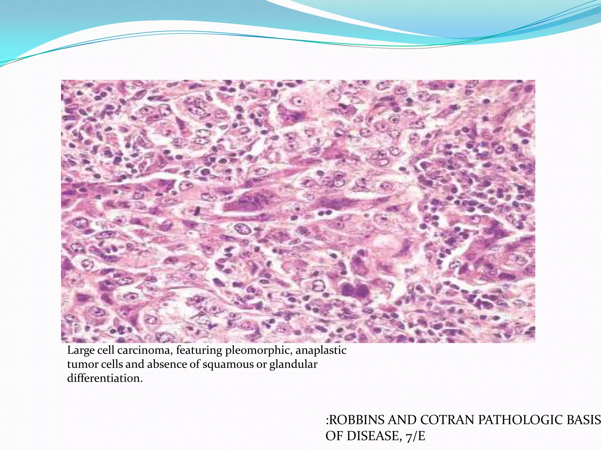 Large cell carcinoma, featuring pleomorphic, anaplastic
tumor cells and absence of squamous or glandular
differentiation.

:ROBBINS AND COTRAN PATHOLOGIC BASIS
OF DISEASE, 7/E

 