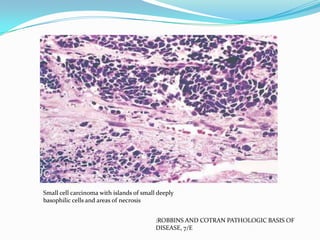 Small cell carcinoma with islands of small deeply
basophilic cells and areas of necrosis
:ROBBINS AND COTRAN PATHOLOGIC BASIS OF
DISEASE, 7/E

 