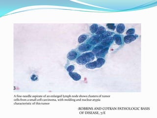 A fine-needle aspirate of an enlarged lymph node shows clusters of tumor
cells from a small cell carcinoma, with molding and nuclear atypia
characteristic of this tumor

:ROBBINS AND COTRAN PATHOLOGIC BASIS
OF DISEASE, 7/E

 