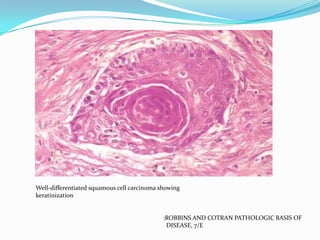 Well-differentiated squamous cell carcinoma showing
keratinization

:ROBBINS AND COTRAN PATHOLOGIC BASIS OF
DISEASE, 7/E

 