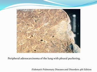 Peripheral adenocarcinoma of the lung with pleural puckering.

:Fishman’s Pulmonary Diseases and Disorders 4th Edition

 