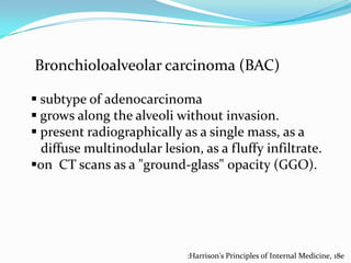 Bronchioloalveolar carcinoma (BAC)
 subtype of adenocarcinoma
 grows along the alveoli without invasion.
 present radiographically as a single mass, as a
diffuse multinodular lesion, as a fluffy infiltrate.
on CT scans as a "ground-glass" opacity (GGO).

:Harrison's Principles of Internal Medicine, 18e

 