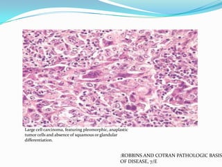 Large cell carcinoma, featuring pleomorphic, anaplastic
tumor cells and absence of squamous or glandular
differentiation.

:ROBBINS AND COTRAN PATHOLOGIC BASIS
OF DISEASE, 7/E

 