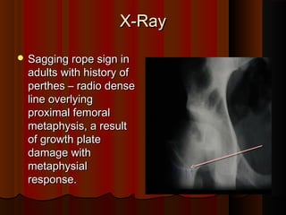 perthes disease | PPT