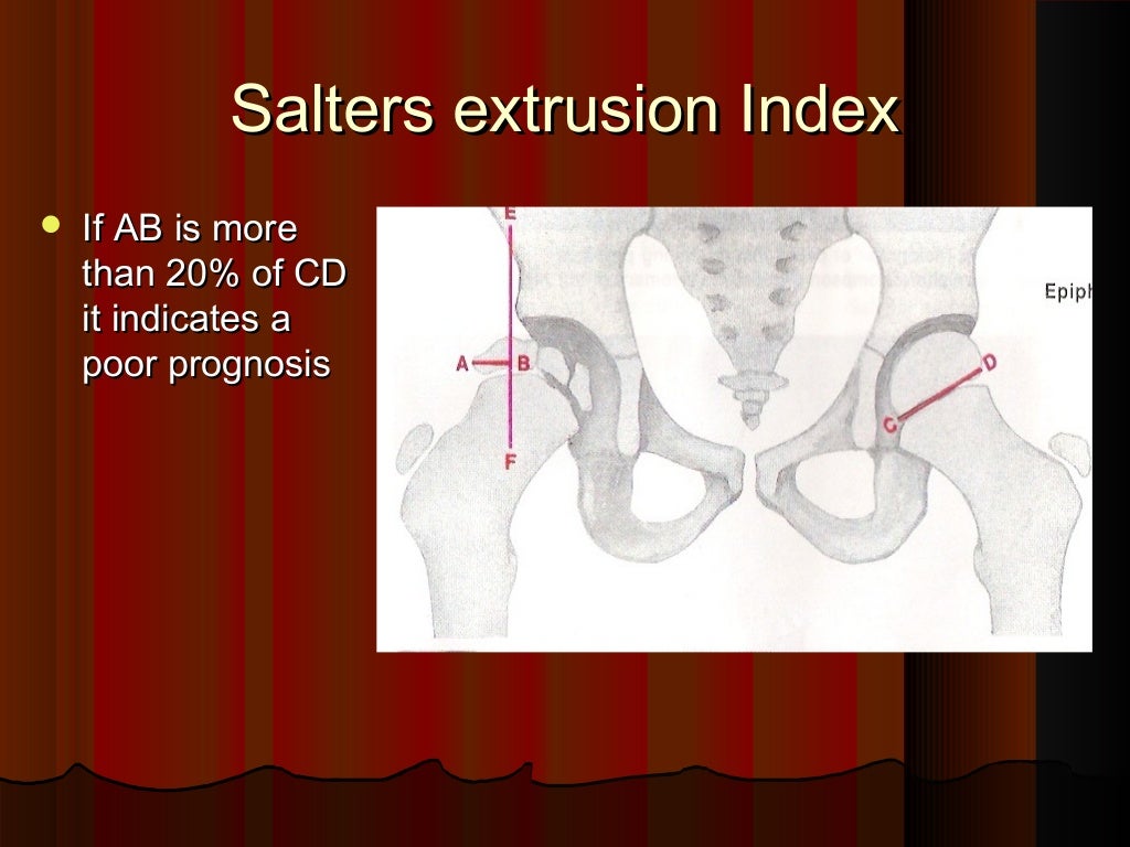 perthes disease