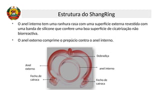 anel interno
Anel
externo
Dobradiça
Fecho de
catraca
Fecho de
catraca
• O anel interno tem uma ranhura rasa com uma superfície externa revestida com
uma banda de silicone que confere uma boa superfície de cicatrização não
biorreactiva.
• O anel externo comprime o prepúcio contra o anel interno.
Estrutura do ShangRing
 