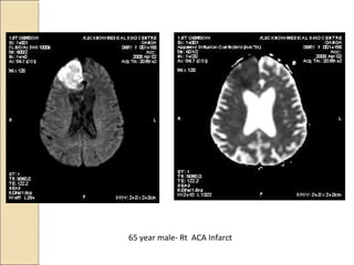 65 year male- Rt ACA Infarct
 