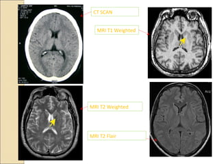 CT SCAN
MRI T1 Weighted
MRI T2 Weighted
MRI T2 Flair
 