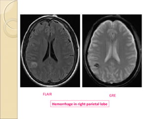 GREFLAIR
Hemorrhage in right parietal lobe
 