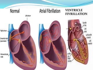 VENTRICLE
FIVRILLATION

 