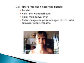 Ciri-ciri Perempuan Sindrom Turner:
       Rendah
       Kulit leher yang berkedut
       Tidak mempunyai ovari
       Tidak mengalami perkembangan ciri-ciri seks
        sekunder yang sempurna
 